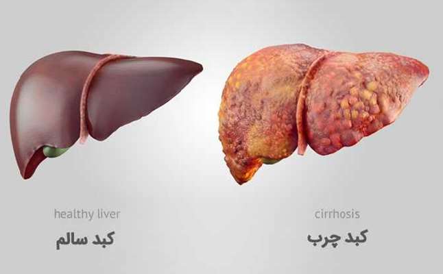 نقش کلیدی آمینواسیدها در بروز بیماری کبد چرب غیرالکلی تایید شد